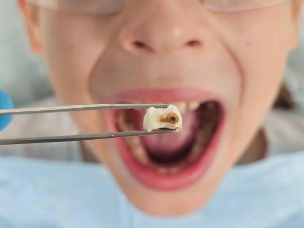 Best Emergency Wisdom Teeth Removal in Batavia, IL